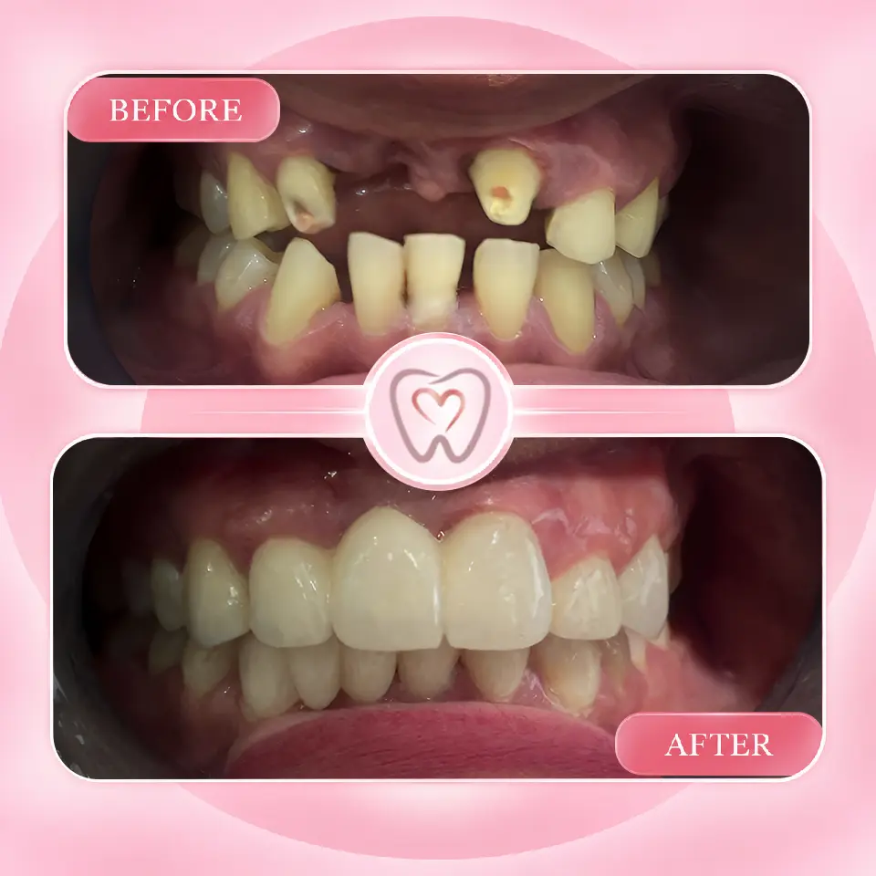 Dental implant procedure