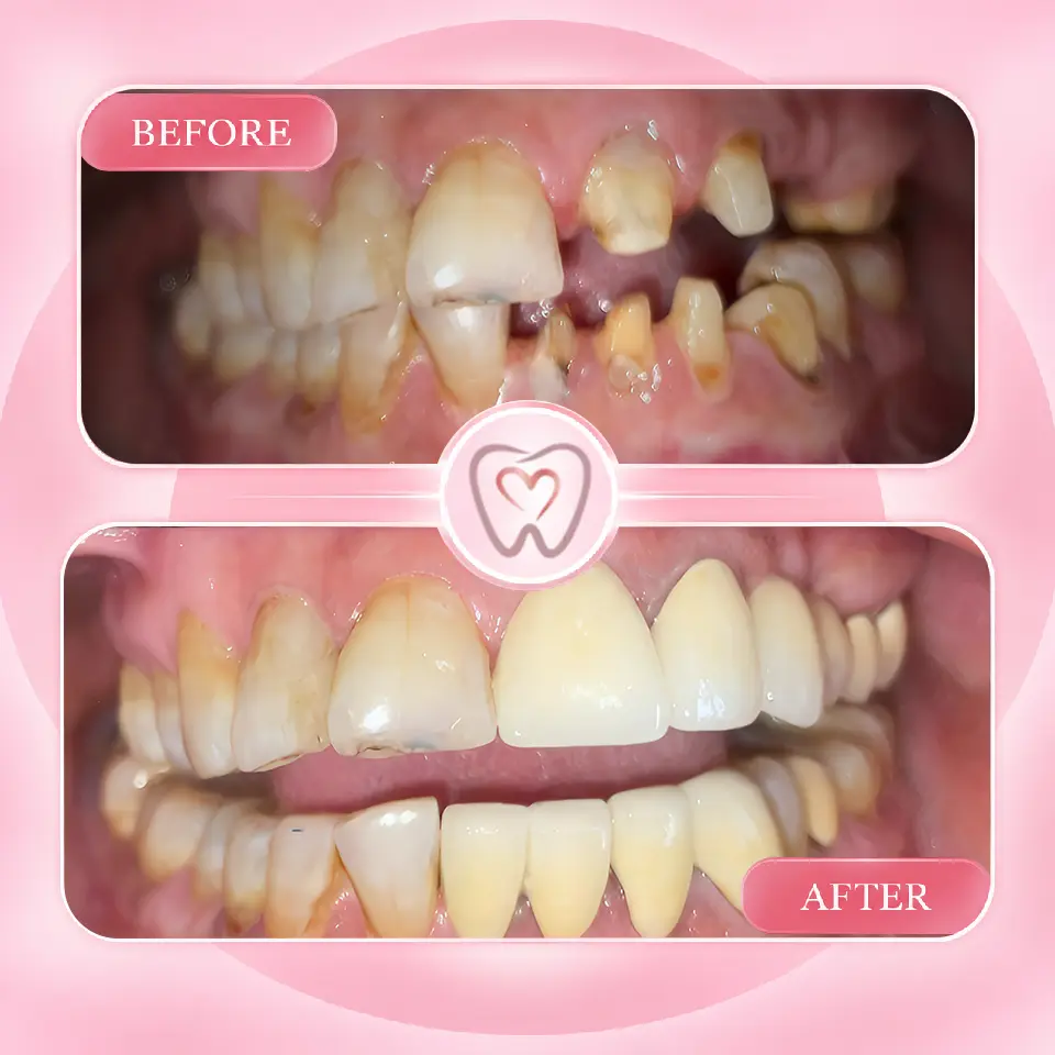 Dental implant procedure